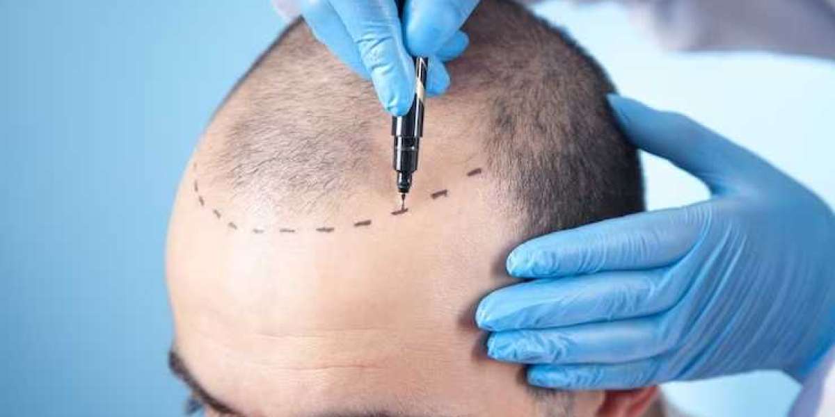 Say Goodbye to Dull Hair with a Hairline Transplant